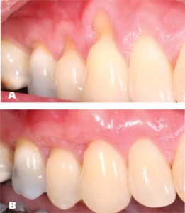 gum recession and teeth whitening