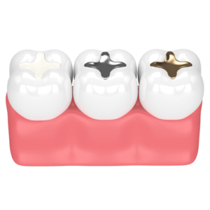 dental-implants types, fillings