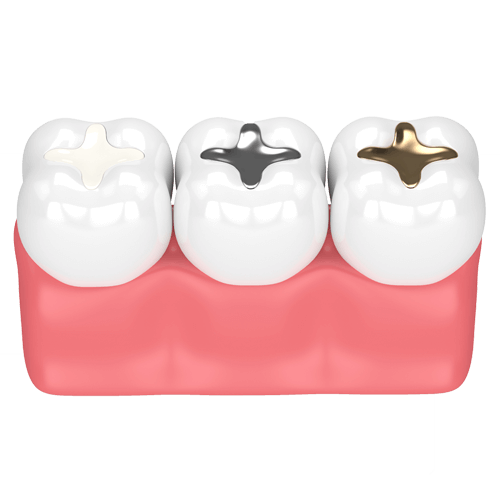 dental-implants types
