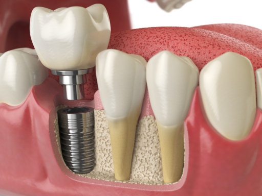 Dental implants and full mouth restorations, Ballard Dental Art in Seattle