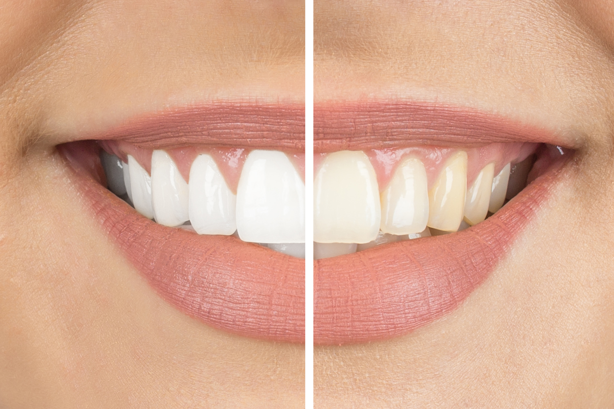 Teeth whitening in office and take-home kits